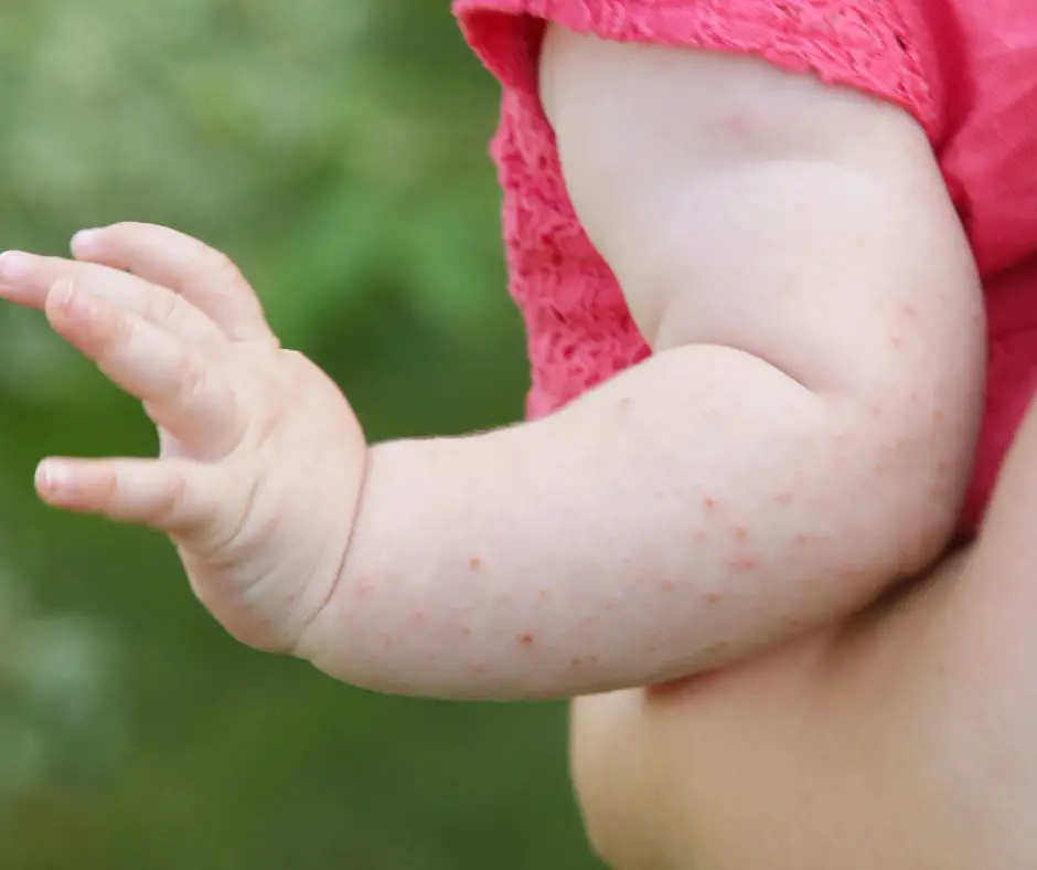 What Causes Heat Rash in Toddlers